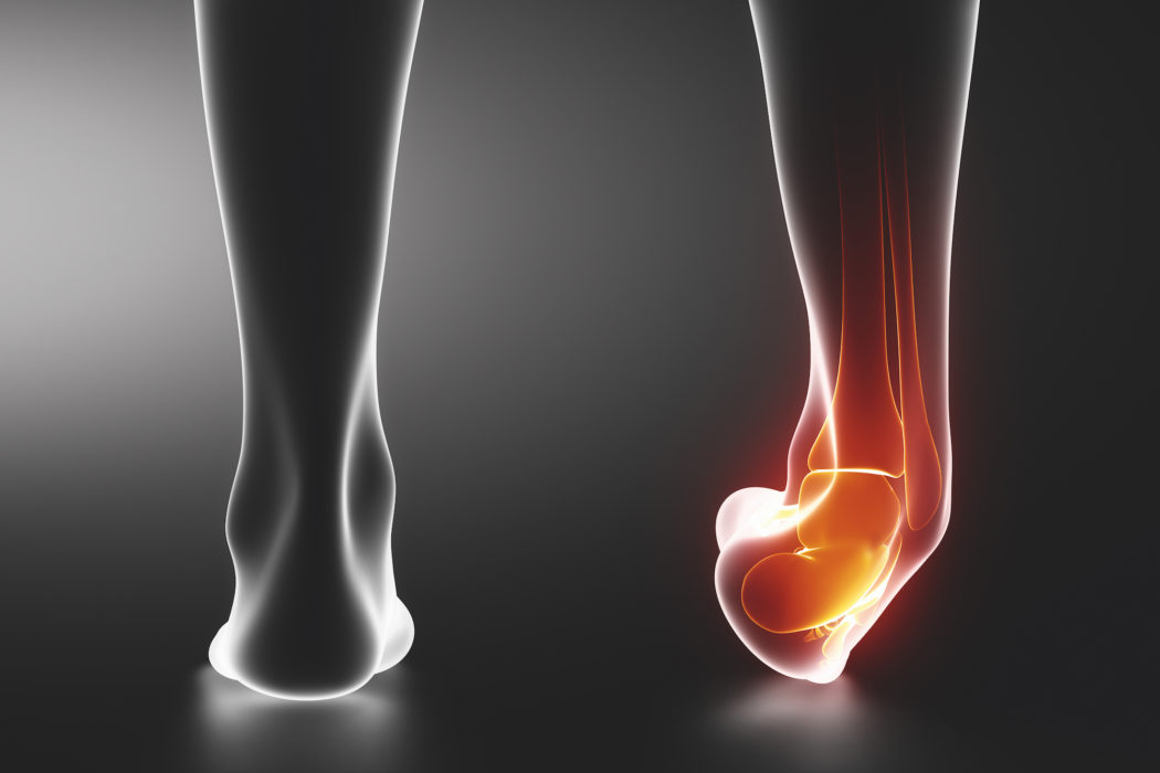 Sprained Sprunggelenk